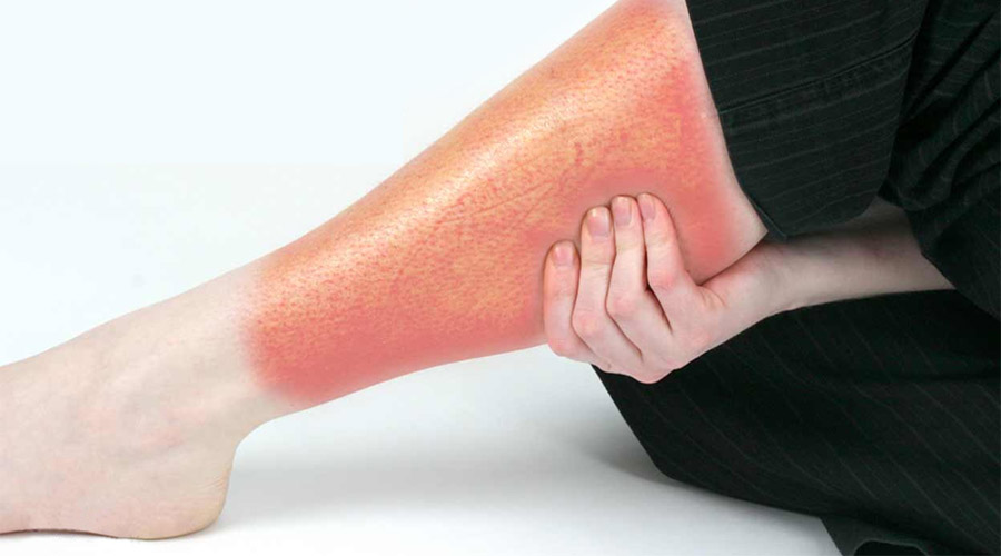 Cellulite chez la femme